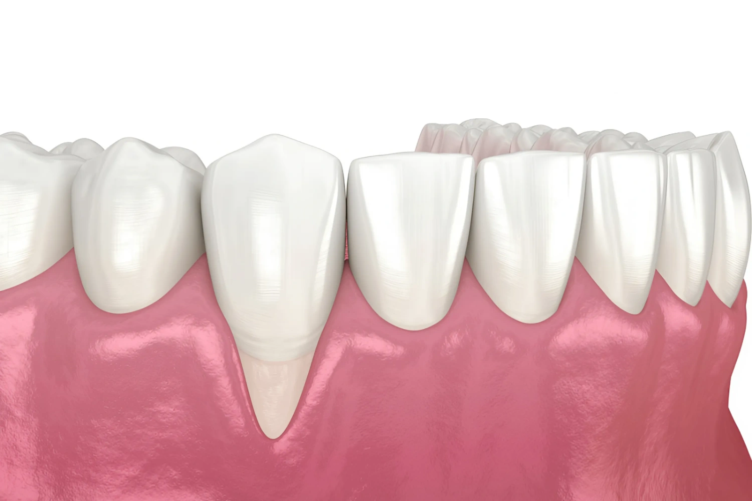 Tụt lợi là tình trạng bờ nướu bao quanh răng di chuyển ra xa thân răng